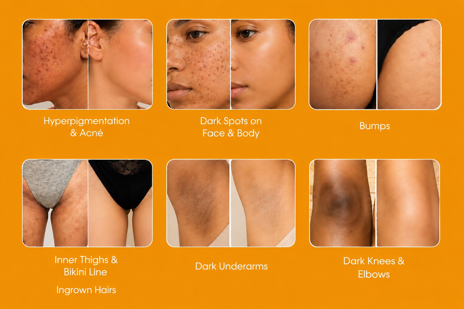Spots & Hyperpigmentation